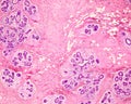 Human breast gland. Secretory units. Adenosis