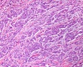 Human breast carcinoma Royalty Free Stock Photo