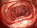 Human colon affected by ulcerative colitis Royalty Free Stock Photo