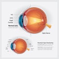 Human Eye Anatomy and Normal Lens