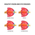 Human Eye Anatomy Set Royalty Free Stock Photo