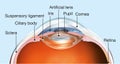 Human eye with artificial lens, labeled, medically 3D illustration