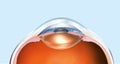 Human eye with artificial lens, labeled, medically 3D illustration