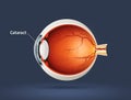 Human eye - cataract Royalty Free Stock Photo