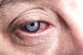 Human eye close-up. There is redness of veins, vessels. Inflammation of the eye Royalty Free Stock Photo