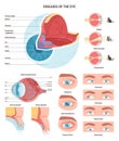 Human eye diseases set. Human vision organ, eyesight and eyelid problem. Royalty Free Stock Photo