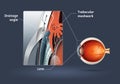 Human eye - glaucoma