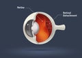 Human eye - retinal detachment