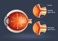 Human eye - retinal detachment Royalty Free Stock Photo