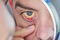 Human eye with yellow eyeball, closeup. Yellow eyes is a symptom of liver disease or hepatitis. Royalty Free Stock Photo