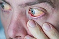 Human eye with yellow eyeball, closeup. Yellow eyes is a symptom of liver disease or hepatitis. Royalty Free Stock Photo