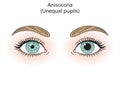 Human Anisocoria diagram medical science