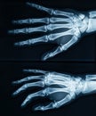 Human adult right hand skeleton x-ray image. Medical and anatomy imagery