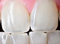 Human Female Incisors