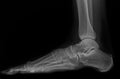 Human foot ankel and leg xray picture Royalty Free Stock Photo