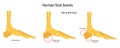 Human foot bones. Plantar and dorsal spur calcaneal spur. Illustration