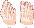 Human foot deformity. Royalty Free Stock Photo