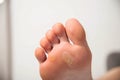 Human foot with a large callus and chicken jowl wart on a white background, close-up. Human papilloma virus