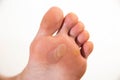 Human foot with a large callus and chicken jowl wart on a white background, close-up. Human papilloma virus
