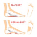 Human foot pathology infographic. Flat foot anatomy