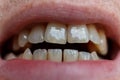 Human front teeth and lips close-up. Natural tooth color.