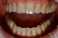 Human front teeth for prosthetics with ceramic veneers. Teeth before treatment.