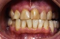 Human front teeth for prosthetics with ceramic veneers. Teeth before treatment. Royalty Free Stock Photo