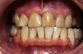 Human front teeth for prosthetics with ceramic veneers. Teeth before treatment.