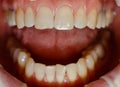 Human front teeth for prosthetics with ceramic veneers. Teeth before treatment.