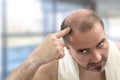 Human hair loss solution concept- adult man hand pointing his bald head Royalty Free Stock Photo