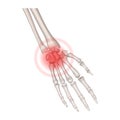 Human hand with inflammation of the carpometacarpal joints Royalty Free Stock Photo