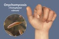 Human hand with onychomycosis