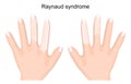 Human hands with symptoms of Raynaud syndrome