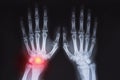 Human hands x ray highlighted in red Royalty Free Stock Photo