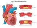 Myocardial Infarction Types diagram medical scienc