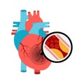 Human heart anatomy with heart attack. Atherosclerotic plaque in the blood vessels.