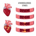 Human heart and Atherosclerosis stages. Royalty Free Stock Photo