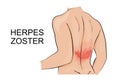 Human infection herpes zoster