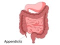 Human intestines anatomy . Abdominal cavity digestive and excretion internal organ. Small and colon intestine with