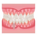 Human Jaw Model With Teeth And Implant. Installation Of Dental Implants Isolated On A White Background. Vector Illustration. Royalty Free Stock Photo