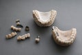 Human jaws, dental implants and crowns flat lay