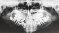 Human jaws on X-ray image