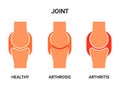 Human joint, healthy, atritis and arthrosis. Joint pain, abrasion of cartilage, inflammation of the joint capsule. Vector