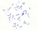 Human karyotype. Chormosomes Royalty Free Stock Photo