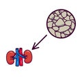 Human kidneys with stones in them.