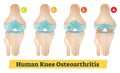 Human Knee Osteoarthritis diagram illustration