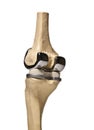 Human knee repacement