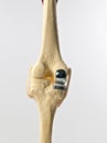 Human knee repacement