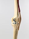 Human knee repacement