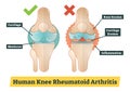 Human Knee Rheumatoid Arthritis, diagram illustration Royalty Free Stock Photo